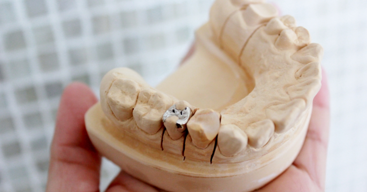 つめ物・かぶせ物