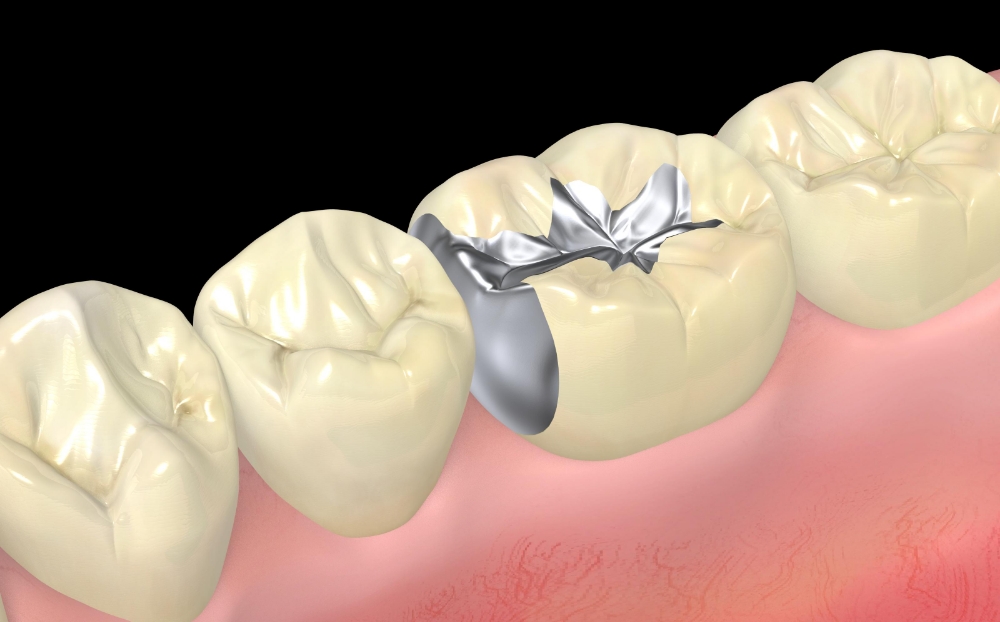 金銀パラジウム合金（保険）