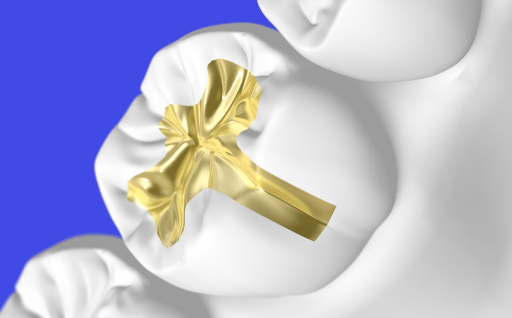 ゴールド（自費）