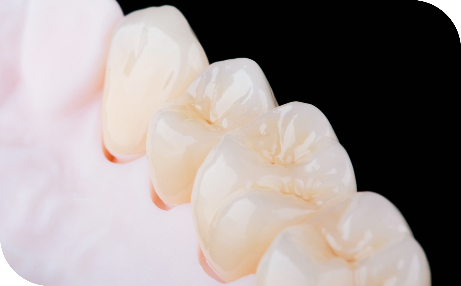 つめ物・かぶせ物